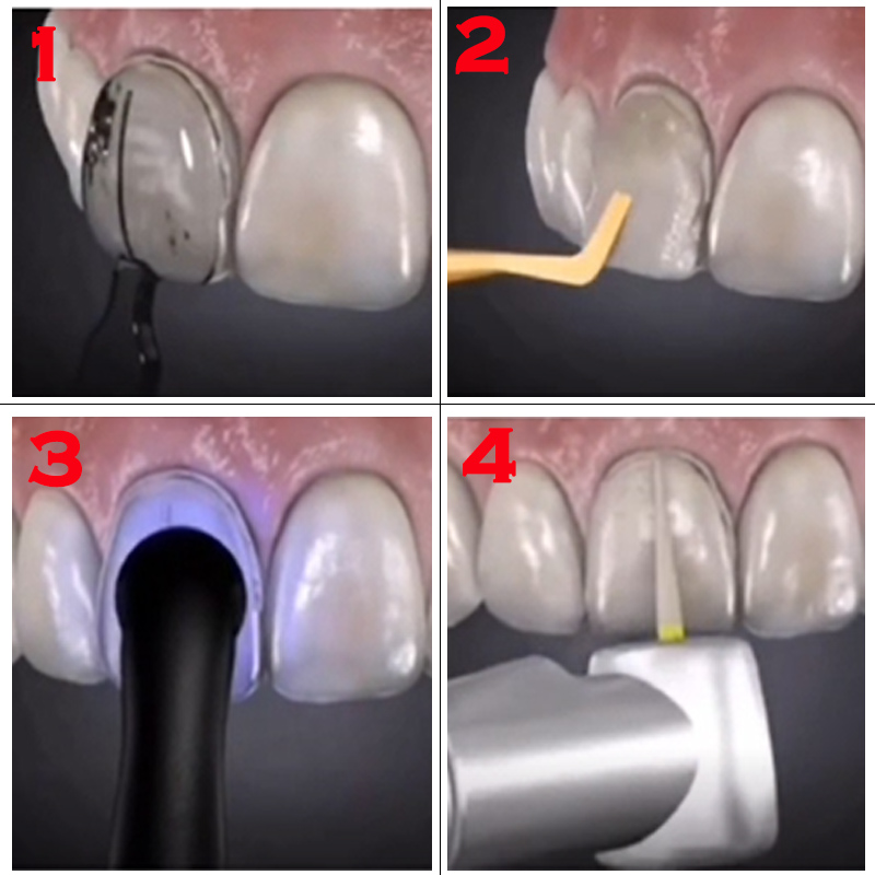 Kompozit Reçine Kaplamalar içi - Teeth Whitening Veneers incelemesi ve fiyatı